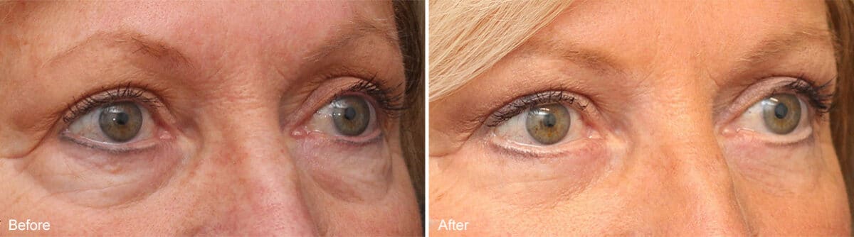 Lower Eyelid Surgery Before and After Photos in Princeton, NJ, Patient 1128