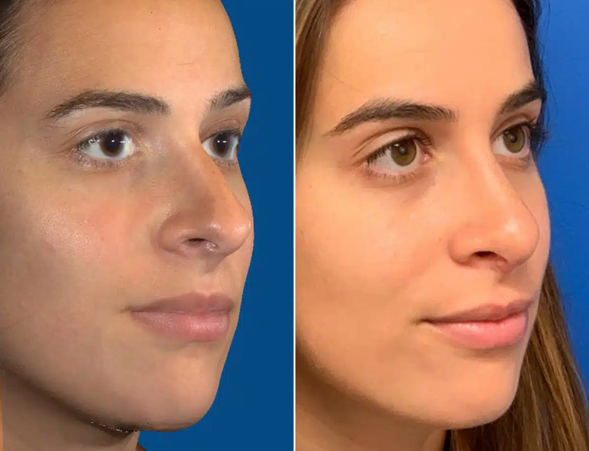 Nasal Bump Before and After Photos in Sewell, NJ, Patient 1718