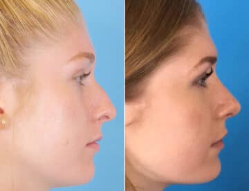 Nasal Bump Before and After Photos in Sewell, NJ, Patient 1728