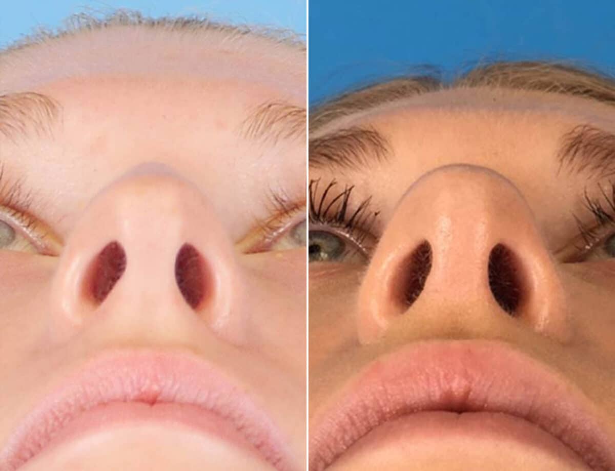 Nasal Bump Before and After Photos in Sewell, NJ, Patient 1728