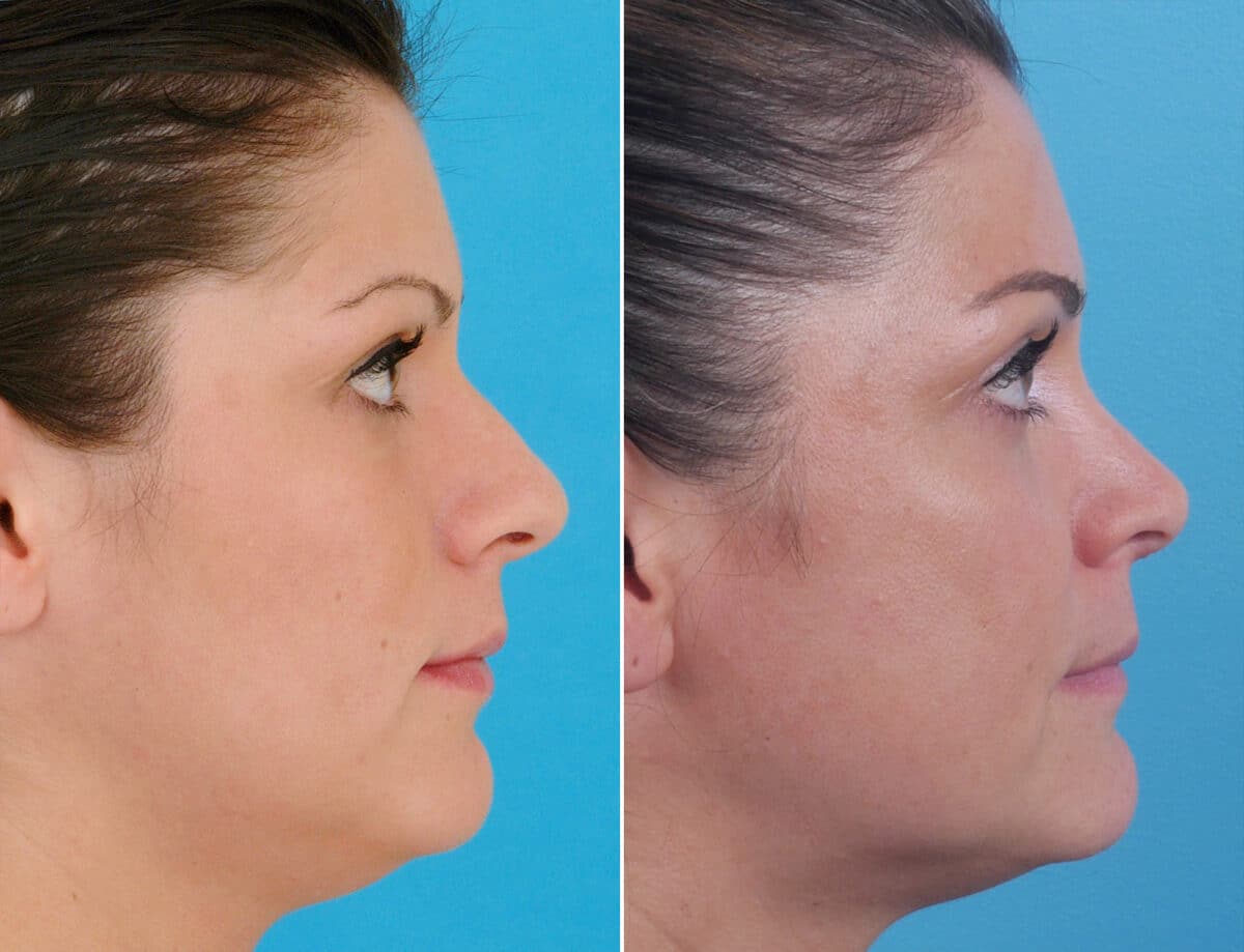 Nasal Bump Before and After Photos in Sewell, NJ, Patient 1743