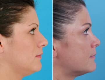 Nasal Bump Before and After Photos in Sewell, NJ, Patient 1743