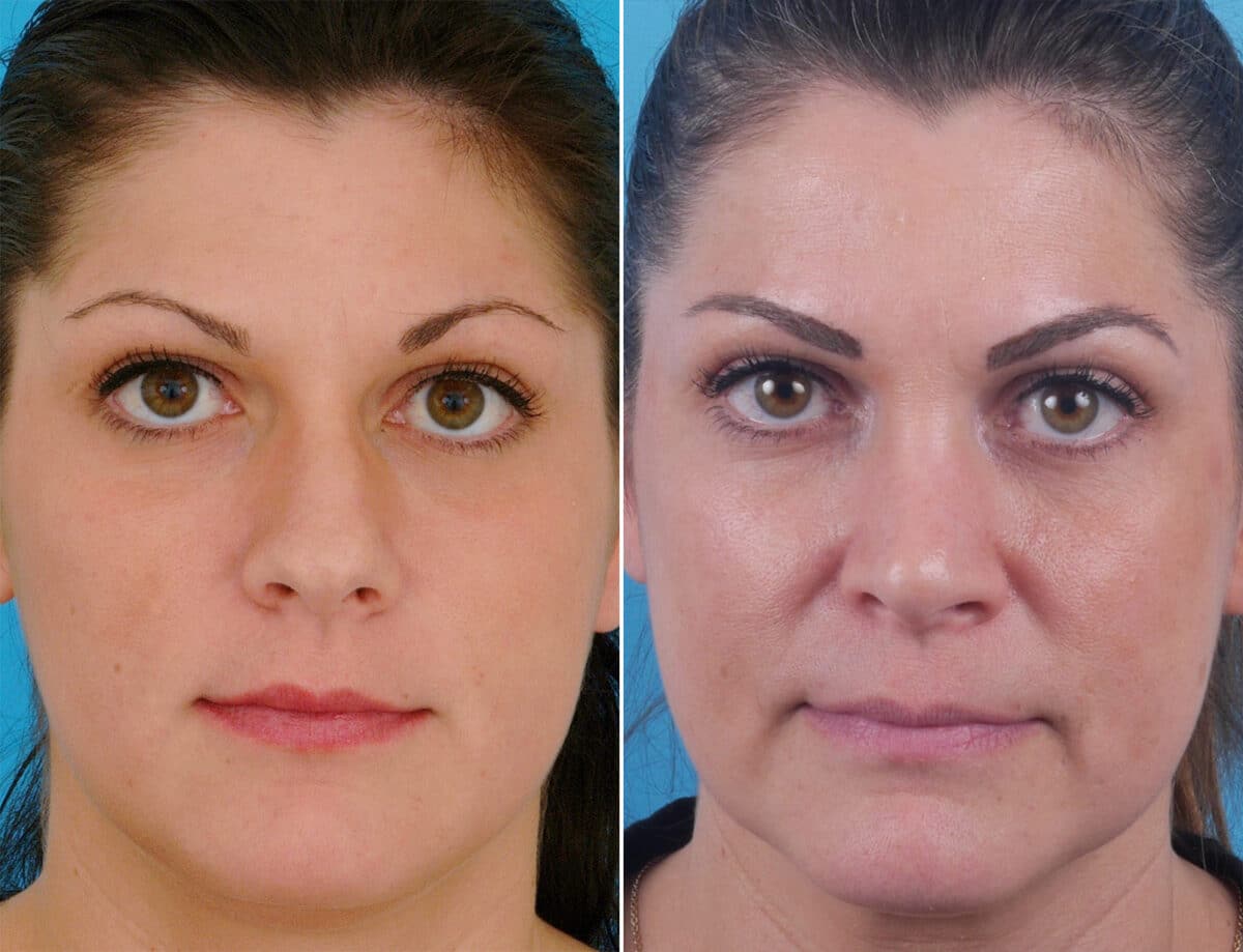 Nasal Bump Before and After Photos in Sewell, NJ, Patient 1743