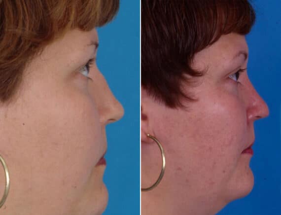 Nasal Bump Before and After Photos in Sewell, NJ, Patient 1698