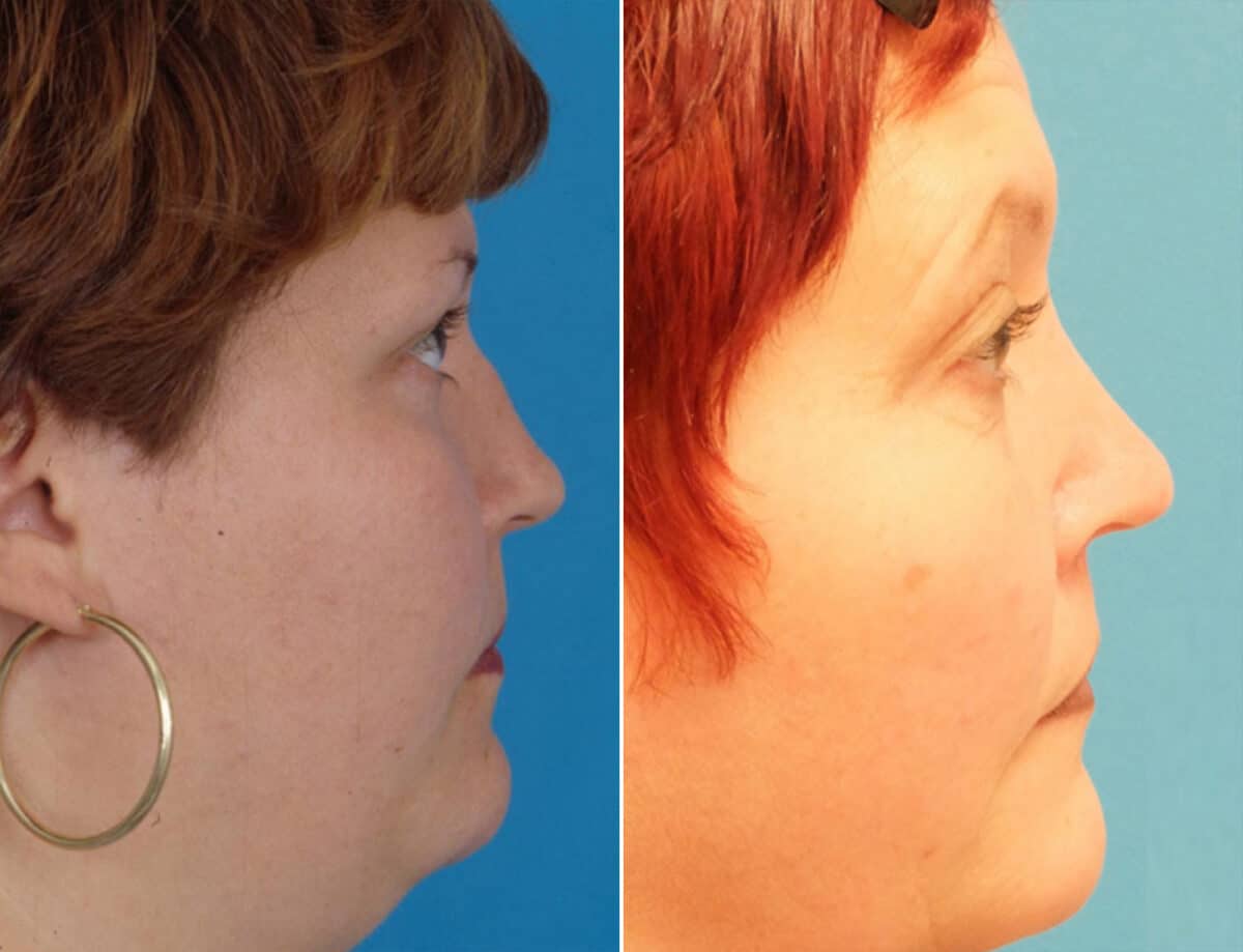 Nasal Bump Before and After Photos in Sewell, NJ, Patient 1698