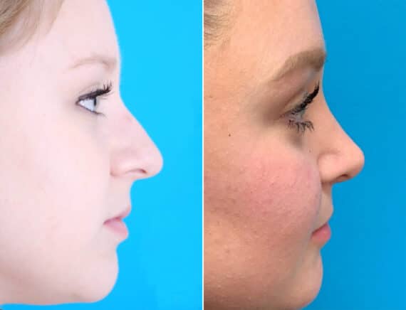 Nasal Bump Before and After Photos in Sewell, NJ, Patient 1711