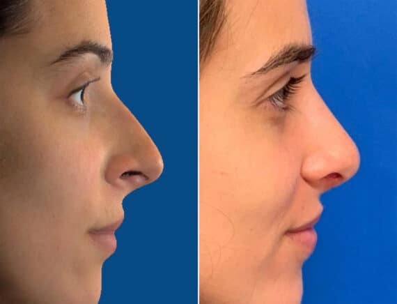 Nasal Bump Before and After Photos in Sewell, NJ, Patient 1718