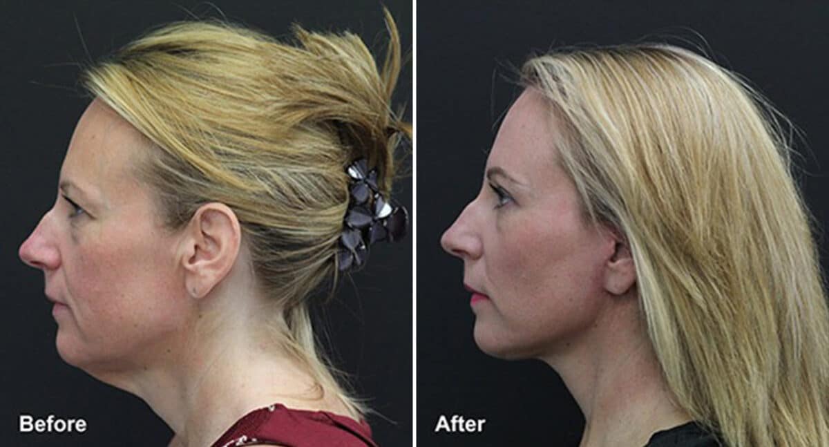 Patient 387, Neck Lift Before and After Photos Neck Lift Before and After Photos in Princeton, NJ, Patient 387