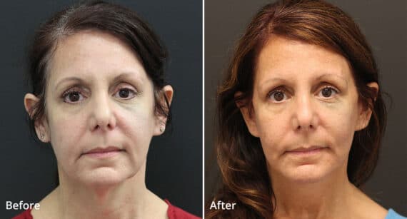 Neck Lift Before and After Photos in Princeton, NJ, Patient 424