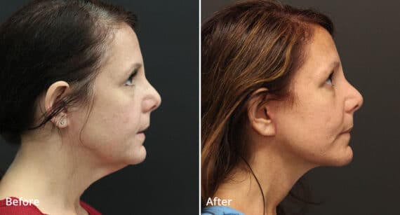 Neck Lift Before and After Photos in Princeton, NJ, Patient 424