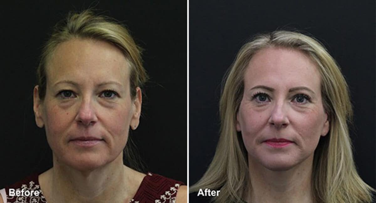Patient 387, Neck Lift Before and After Photos Neck Lift Before and After Photos in Princeton, NJ, Patient 387