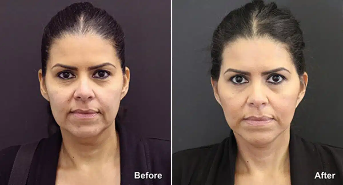 Neck Lift Before and After Photos in Princeton, NJ, Patient 434