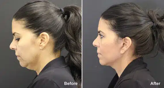 Neck Lift Before and After Photos in Princeton, NJ, Patient 434