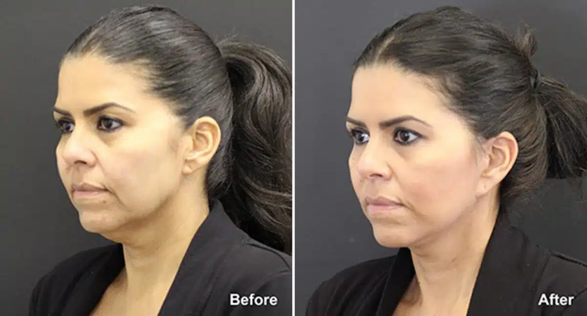 Neck Lift Before and After Photos in Princeton, NJ, Patient 434