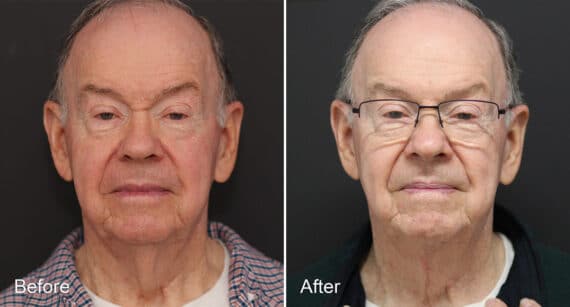 Neck Lift Before and After Photos in Princeton, NJ, Patient 462