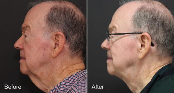 Neck Lift Before and After Photos in Princeton, NJ, Patient 462