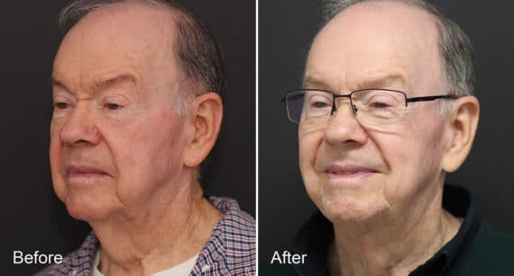 Neck Lift Before and After Photos in Princeton, NJ, Patient 462