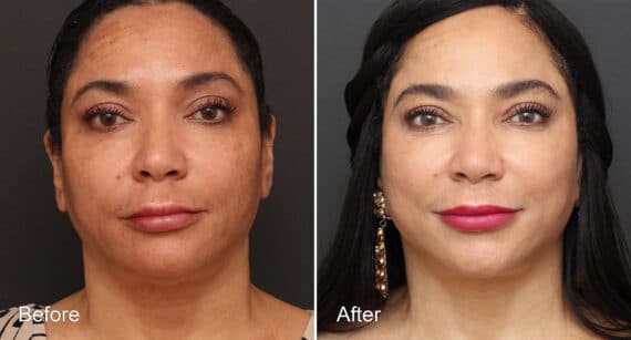 Neck Lift Before and After Photos in Princeton, NJ, Patient 472