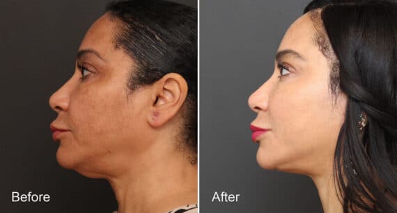 Neck Lift Before and After Photos in Princeton, NJ, Patient 472