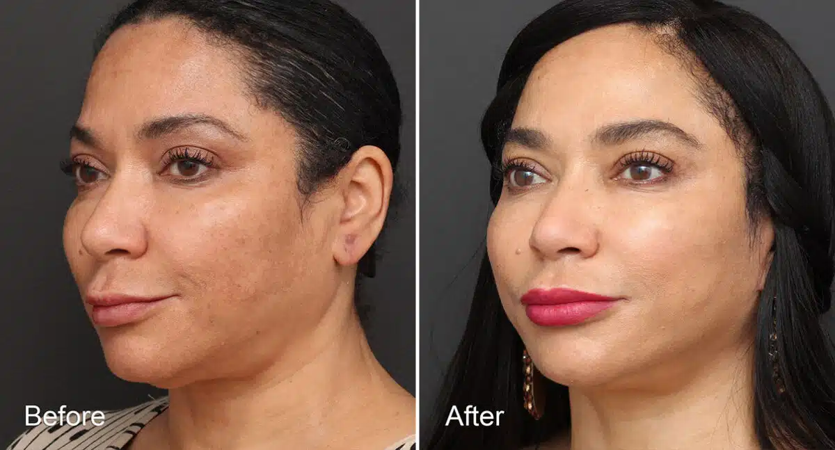 Neck Lift Before and After Photos in Princeton, NJ, Patient 472