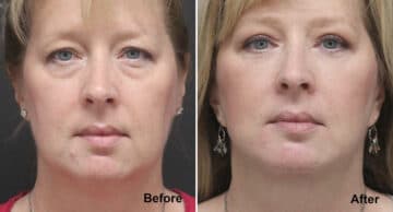 Neck Lift Before and After Photos in Princeton, NJ, Patient 414