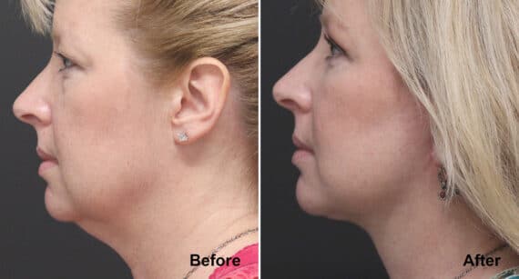 Neck Lift Before and After Photos in Princeton, NJ, Patient 414