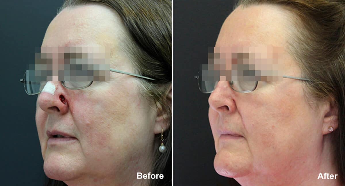 Reconstructive Surgery Before and After Photos in , , Patient 1214