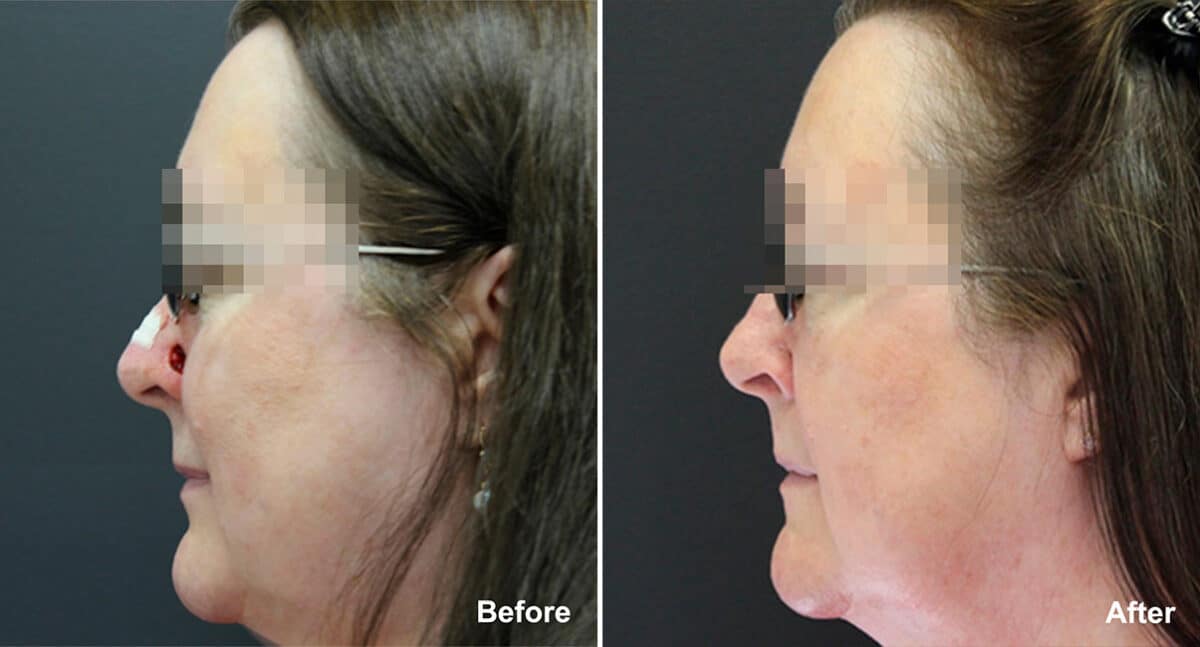 Reconstructive Surgery Before and After Photos in , , Patient 1214