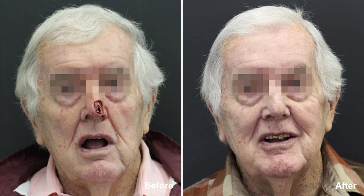 Reconstructive Surgery Before and After Photos in Princeton, NJ, Patient 1207