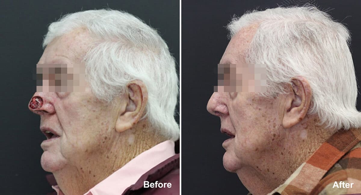 Reconstructive Surgery Before and After Photos in Princeton, NJ, Patient 1207