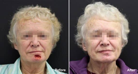 Reconstructive Surgery Before and After Photos in Princeton, NJ, Patient 1227