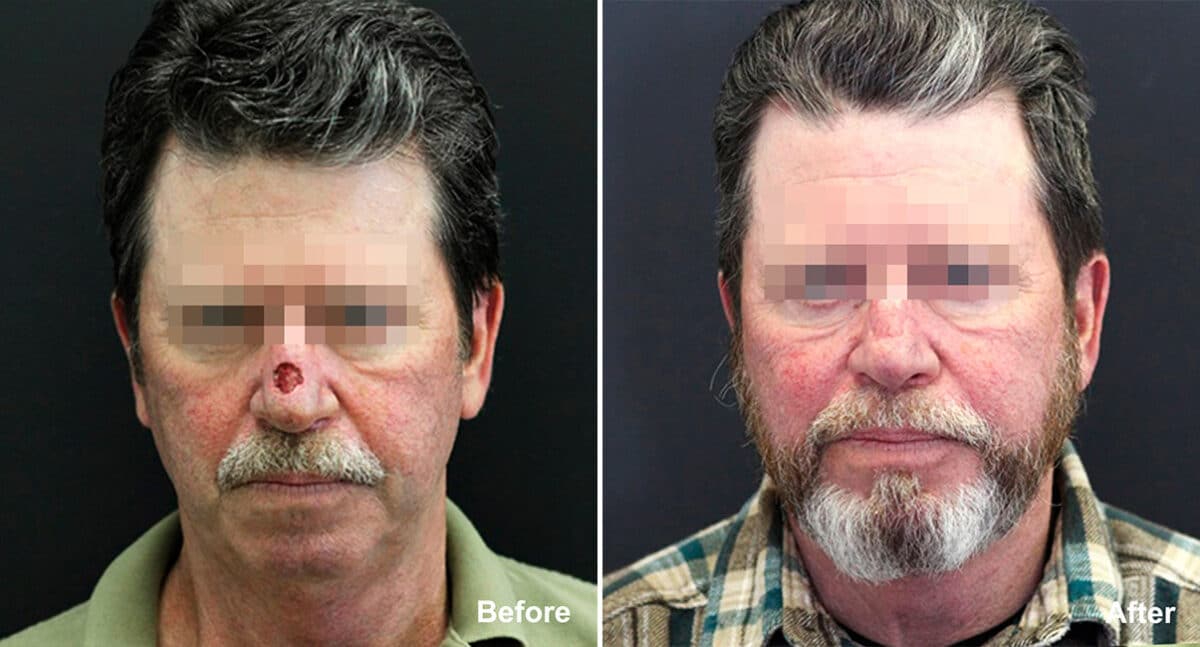 Reconstructive Surgery Before and After Photos in Princeton, NJ, Patient 1242