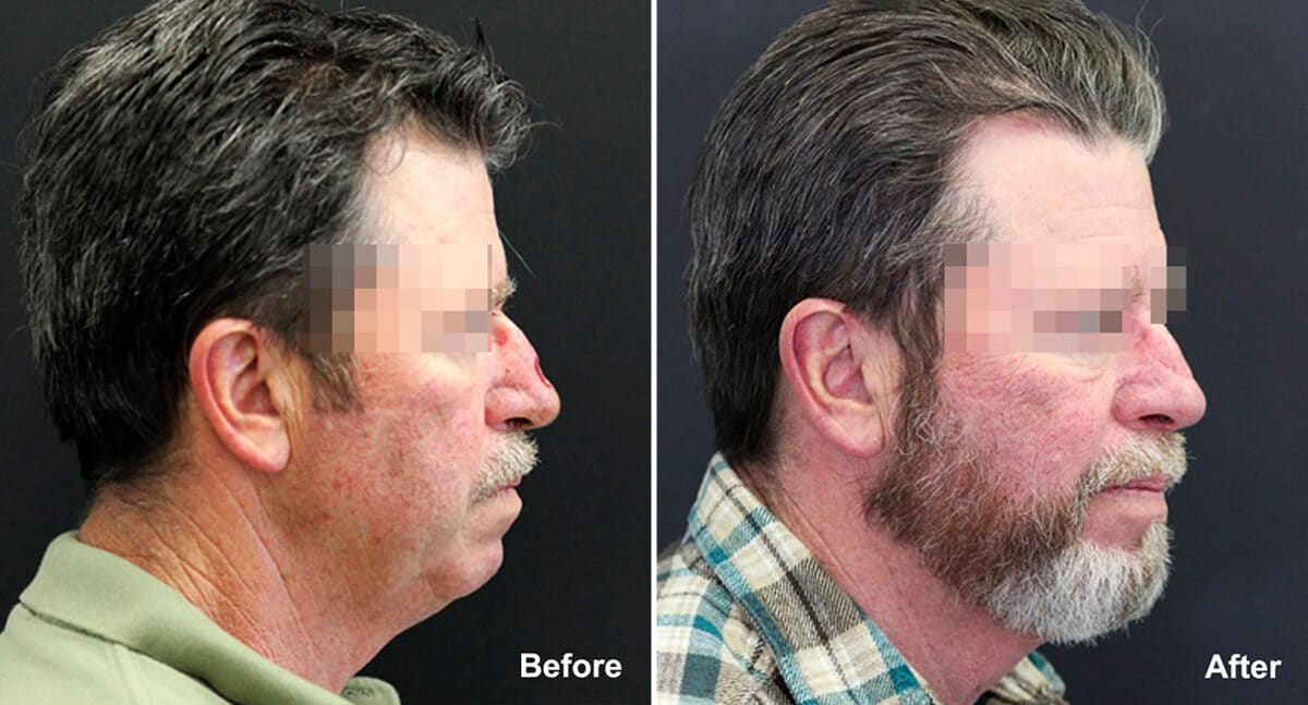 Reconstructive Surgery Before and After Photos in Princeton, NJ, Patient 1242