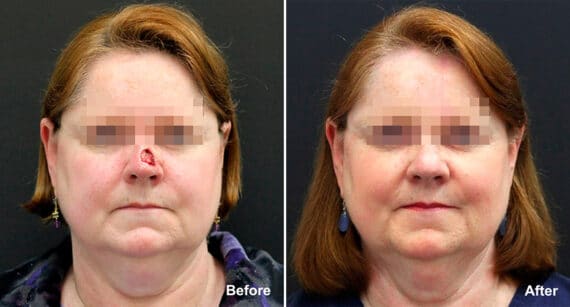 Reconstructive Surgery Before and After Photos in Princeton, NJ, Patient 1258