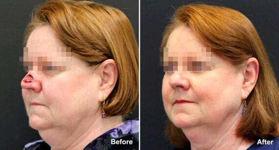 Reconstructive Surgery Before and After Photos in Princeton, NJ, Patient 1258