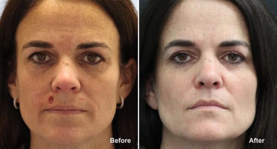 Reconstructive Surgery Before and After Photos in Princeton, NJ, Patient 1272