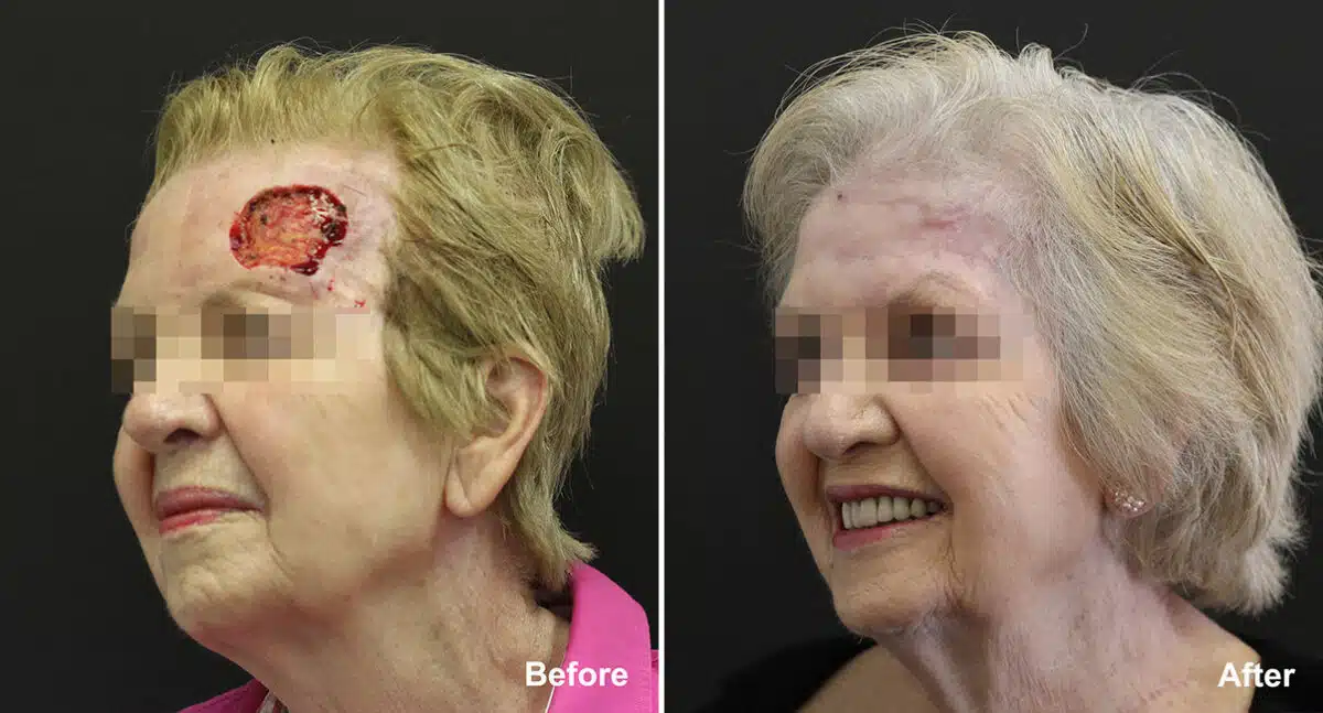 Reconstructive Surgery Before and After Photos in Princeton, NJ, Patient 1192