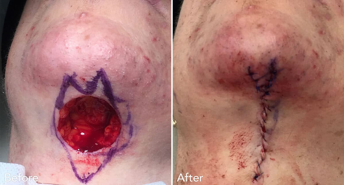 Reconstructive Surgery Before and After Photos in Philadelphia, PA, Patient 1289