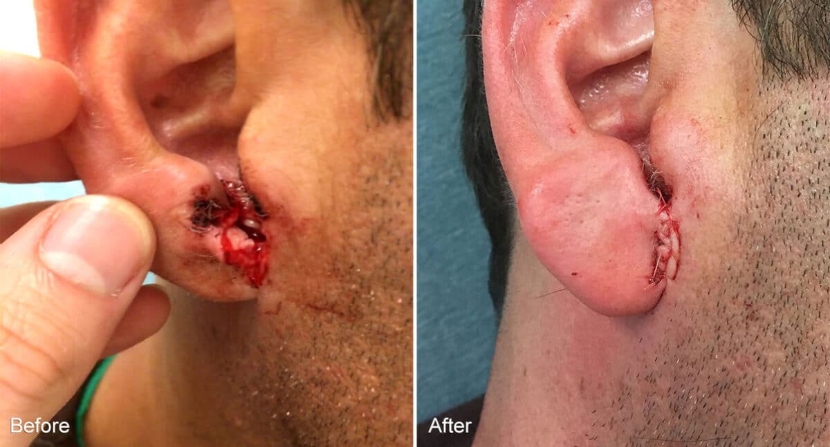 Reconstructive Surgery Before and After Photos in Philadelphia, PA, Patient 1293