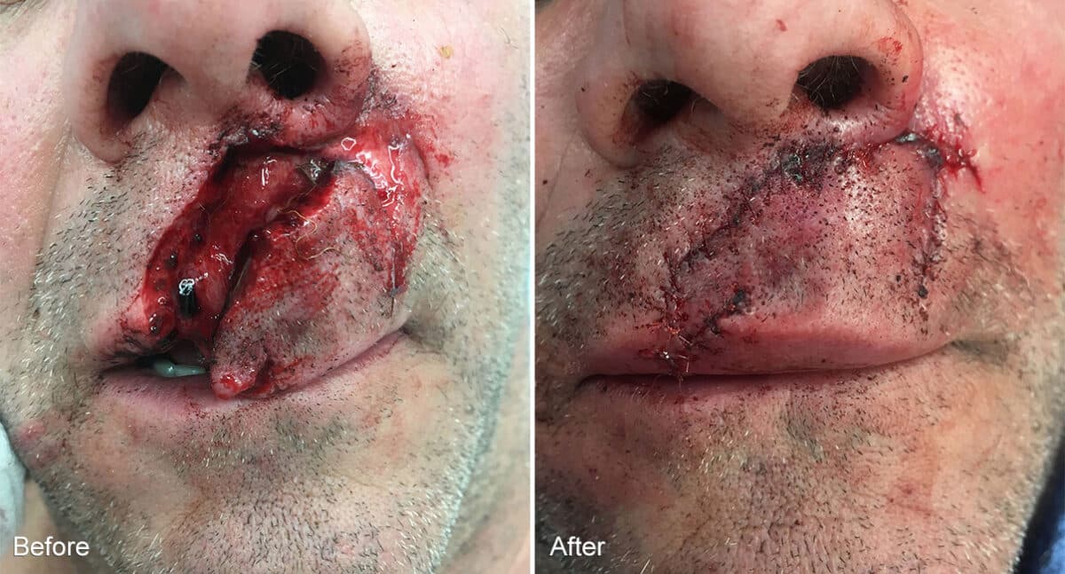 Reconstructive Surgery Before and After Photos in Philadelphia, PA, Patient 1297