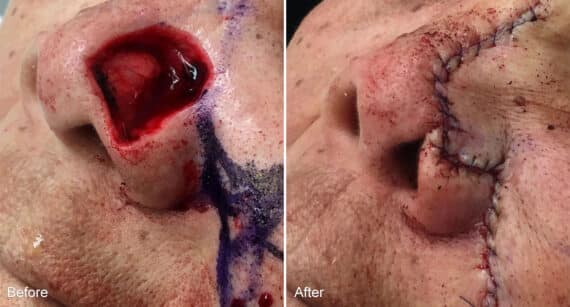 Reconstructive Surgery Before and After Photos in Philadelphia, PA, Patient 1301