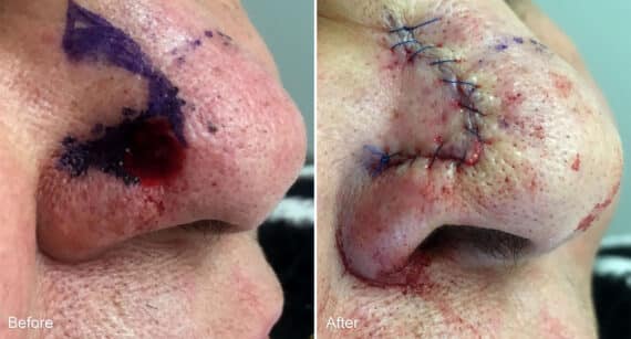 Reconstructive Surgery Before and After Photos in Philadelphia, PA, Patient 1309