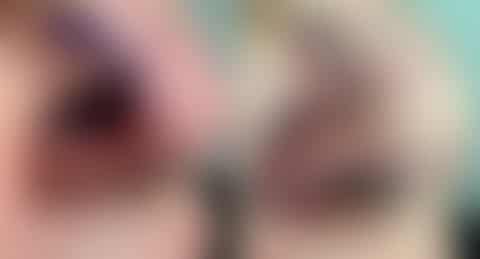 Reconstructive Surgery Before and After Photos in Philadelphia, PA, Patient 1309