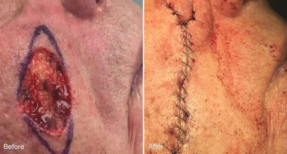 Reconstructive Surgery Before and After Photos in Philadelphia, PA, Patient 1313