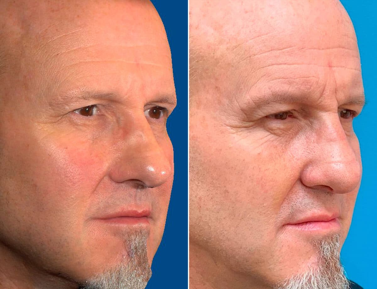 Patient 1664, Revision Rhinoplasty Before and After Photos Revision Rhinoplasty Before and After Photos in Sewell, NJ, Patient 1664