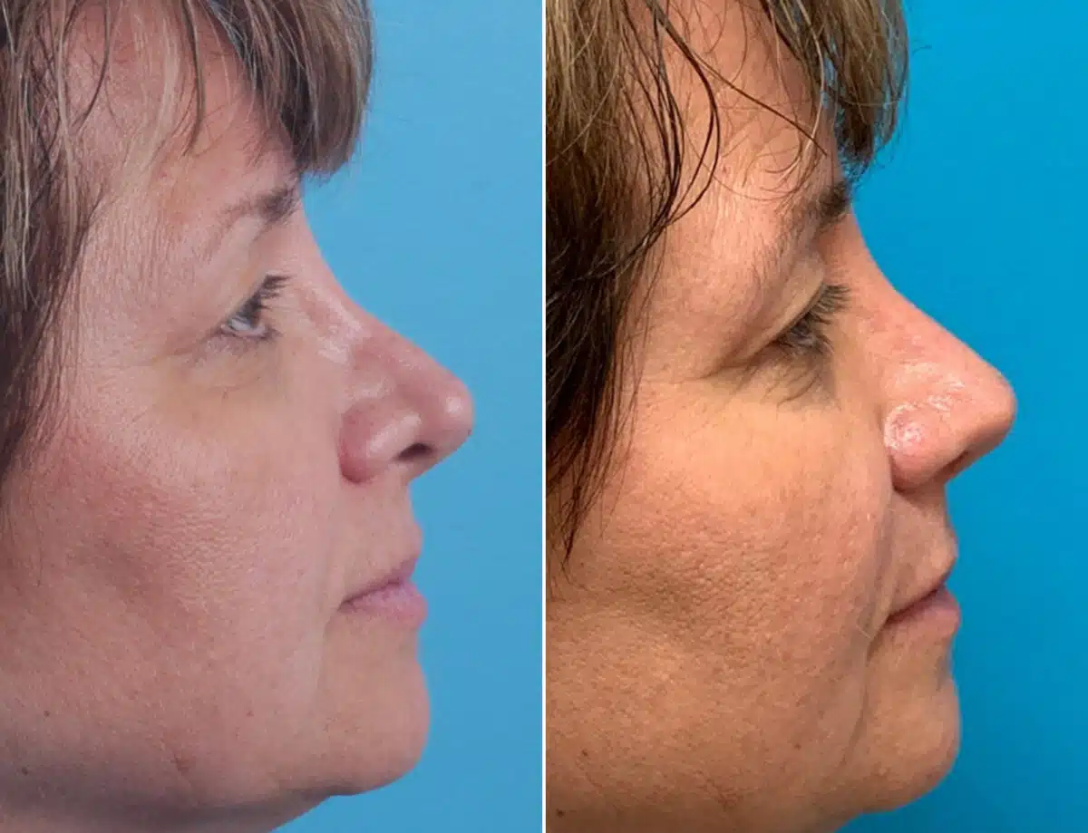 Revision Rhinoplasty Before and After Photos in Sewell, NJ, Patient 1671