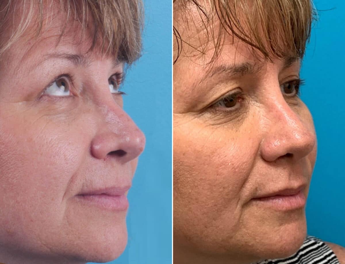 Revision Rhinoplasty Before and After Photos in Sewell, NJ, Patient 1671