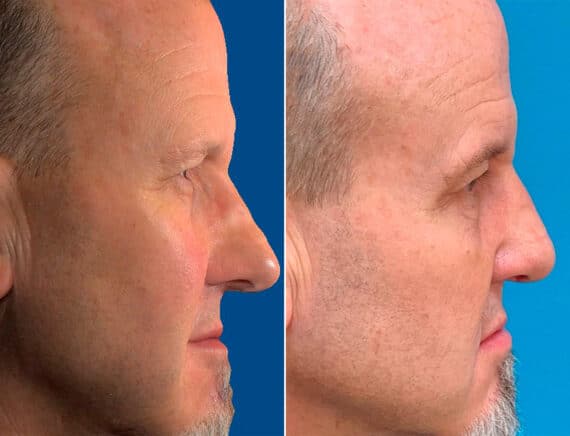 Revision Rhinoplasty Before and After Photos in Sewell, NJ, Patient 1664