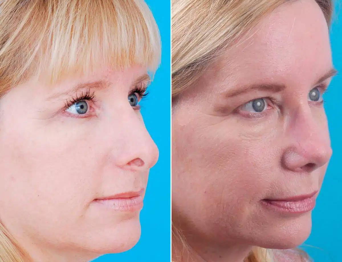 Revision Rhinoplasty Before and After Photos in Sewell, NJ, Patient 1681