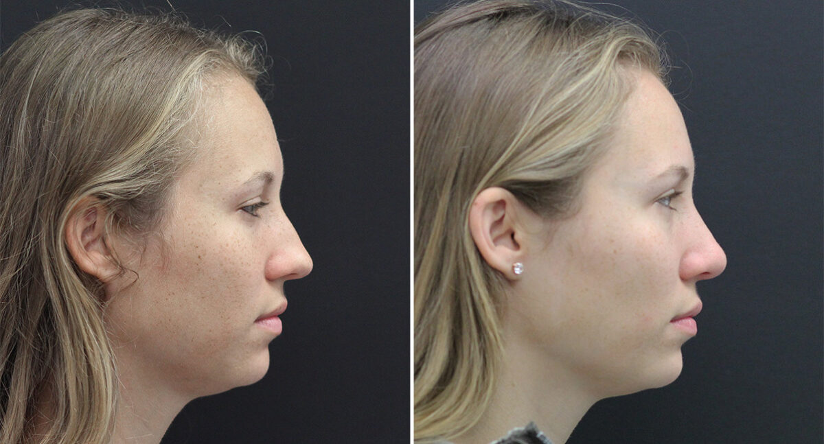 Rhinoplasty Before and After Photos in Princeton, NJ, Patient 671